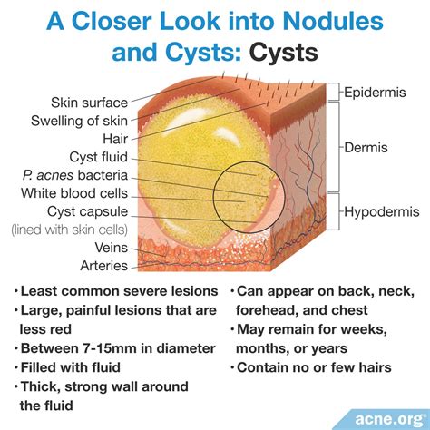 What Causes Cysts