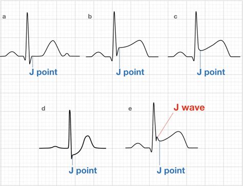 What Causes J Point Elevation