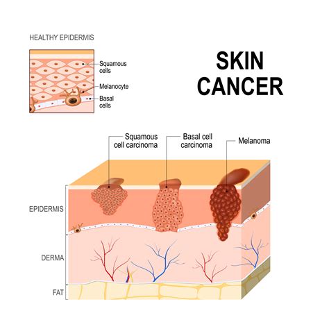 What Causes Melanoma