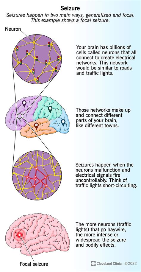 What Causes Seizures