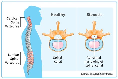 What Causes Spinal Stenosis