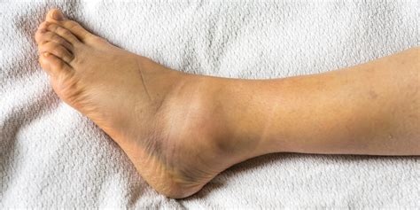 What Causes Swollen Ankles