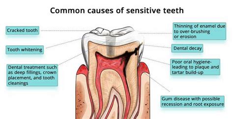What Causes Tooth Sensitivity