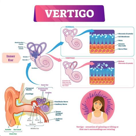 What Causes Vertigo