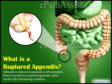 What Causes Your Appendix To Burst