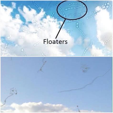 What Cures Eye Floaters