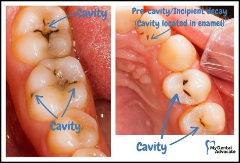 What Do Cavities Feel Like