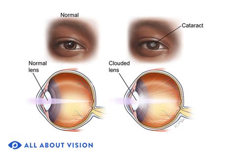 What Does Cataracts Look Like