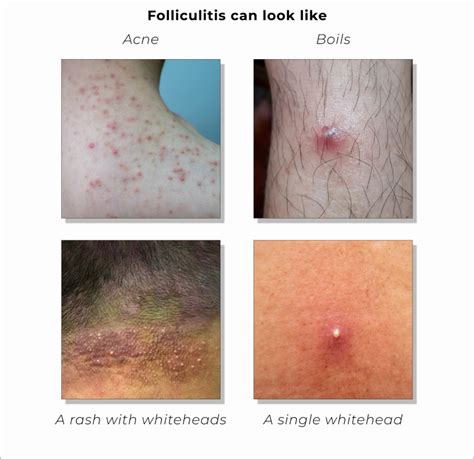 What Does Folliculitis Look Like