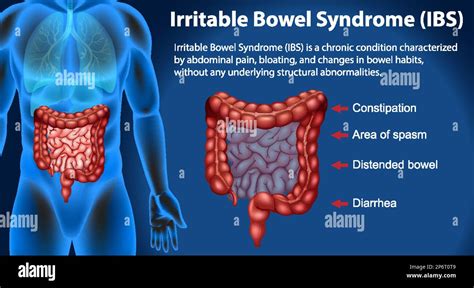 What Does Ibs Feel Like