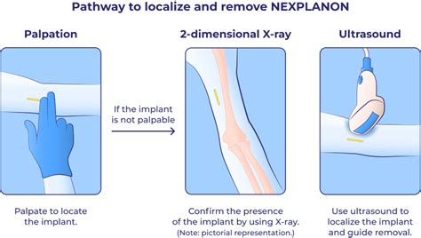 What Happens When Nexplanon Expires