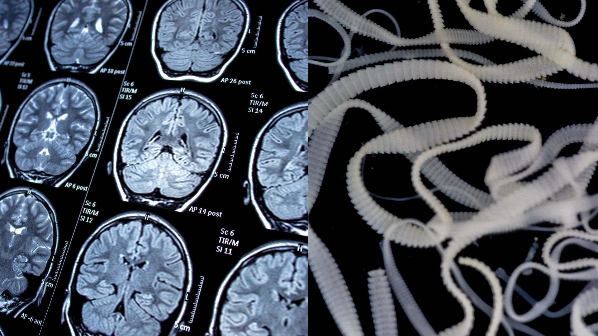What Insect Eats Your Brain: The Truth About Parasitic Myiasis