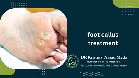 What Is A Callus