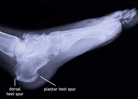 What Is A Heel Spur