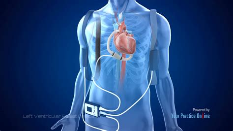 What Is A Lvad