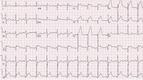 What Is A Stemi
