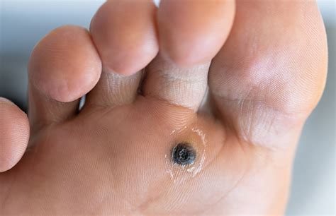 What Is A Wart