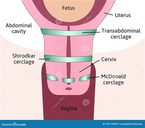 What Is Cervical Stitch