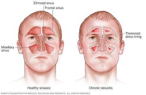 What Is Chronic Sinusitis