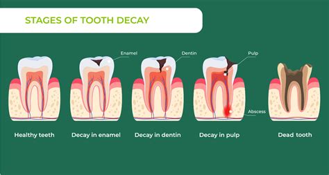What Prevents Tooth Decay