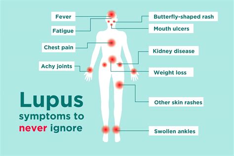 When Does Lupus Happen