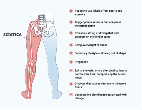 Will Sciatica Go Away